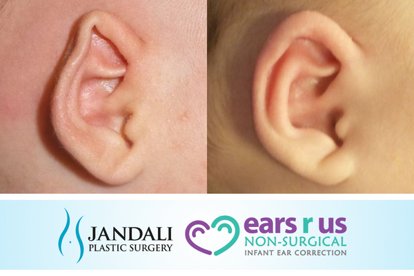 Jandali ear molding