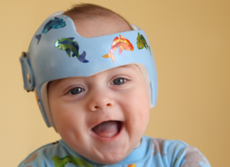 Let’s Talk About Plagiocephaly, Baby! A baby wearing a a doc band.