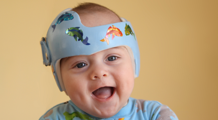 A baby wearing a a doc band.